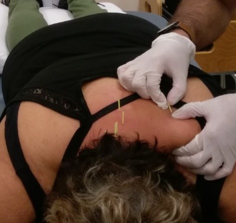Dry Needling